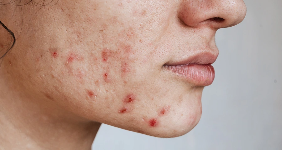 Θεραπεία κατά της Ακμής Acne Control Line